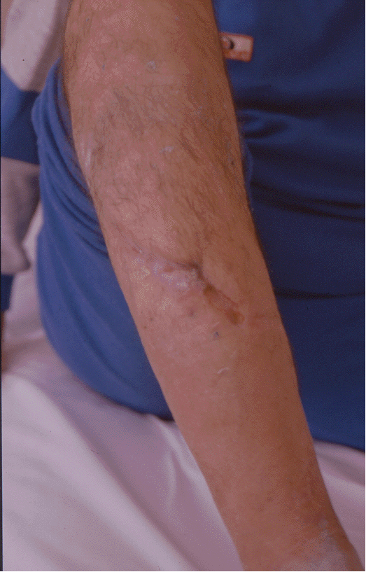 Próby stosowania propolisu w leczeniu ran, oparzeń i odleżyn