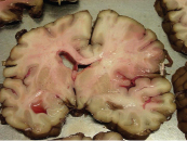 Apitoksynoterapia refleksoryczna a udary