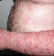 Alergenne oddziaływanie miodu na organizm człowieka