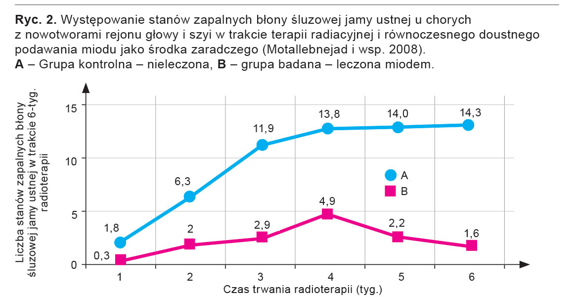 Występowanie stanów zapalnych błony śluzowej jamy ustnej u chorych z nowotworami głowy i szyi w trakcie terapii radiacyjnej i równoczesnego doustnego podawania miodu jako środka zaradczego (wg Biswal i wsp. 2003).